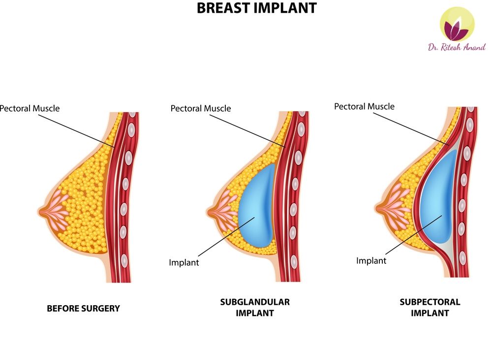 breast-implant