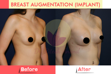 breast_augmentation