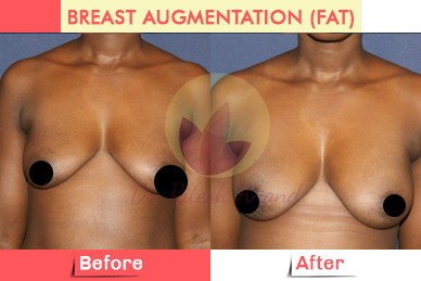 breast_augmentation3