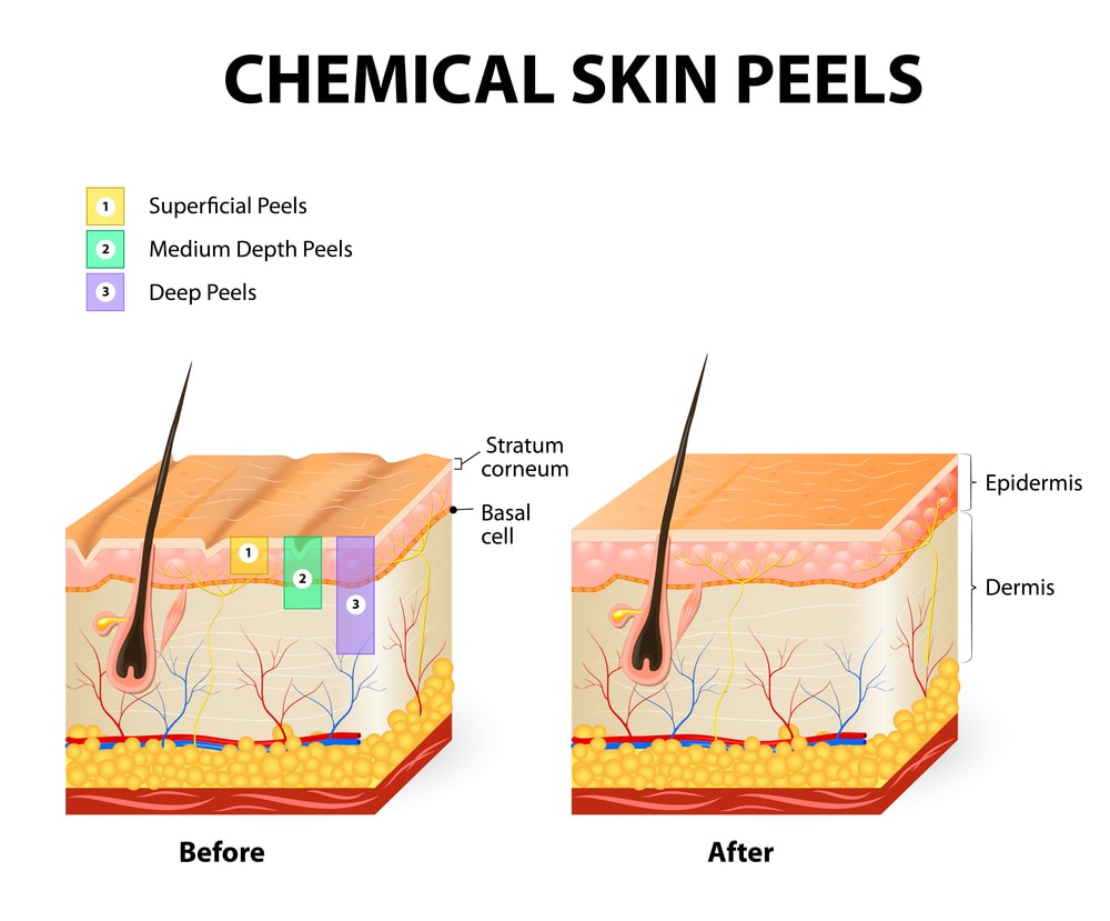 Chemical Peeling