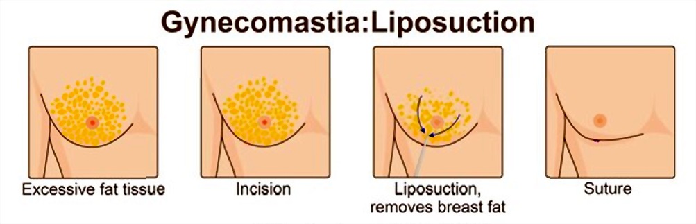 Gynecomastia-surgery1