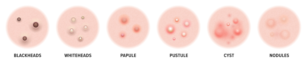 Types of Acne